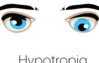Hypotropia Eyes Graphic - hypotropia amblyopia strabismus vergence disorders exotropia divergence excess strabismic refractive esotropia exotropia