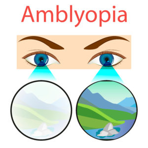 Amblyopia image