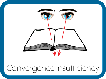 Convergence Insufficiency Eyes Graphic
