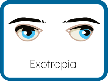 Exotropia Eyes Graphic