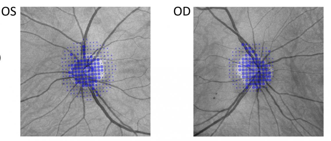 Example of lesion-customized grids placed on the physiological blind spots of a normally-sighted person. VVP is precise enough to measure individual blood vessels leaving the optic nerve head.