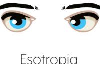 Esotropia Eyes Graphic - esotropia amblyopia strabismus vergence disorders exotropia divergence excess strabismic refractive esotropia exotropia