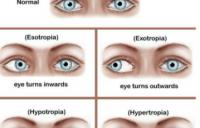 types of strabismus - strabismus esotropia exotropia squint